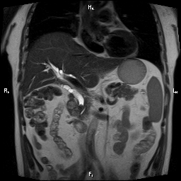 Choledocholithiasis | Image | Radiopaedia.org