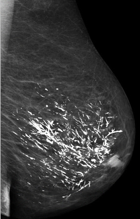 What mastitis looks like: photos