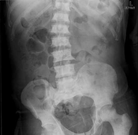 Metastatic prostate cancer - superscan | Image | Radiopaedia.org