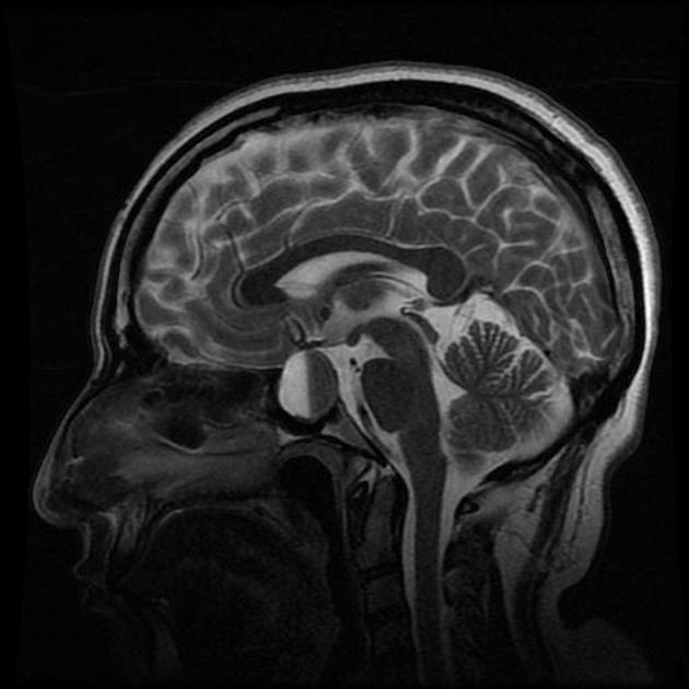 Pituitary apoplexy | Radiology Reference Article | Radiopaedia.org