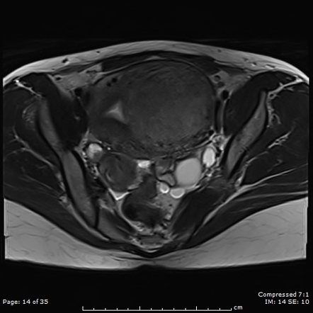 Endometrioma | Radiology Reference Article | Radiopaedia.org