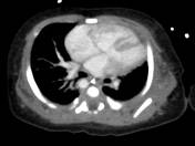 Conotruncal cardiac anomalies | Radiology Reference Article ...