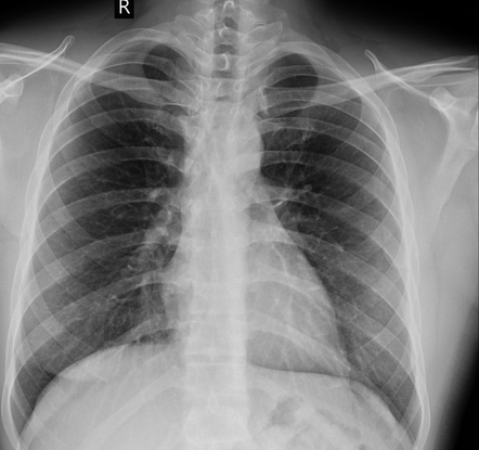 Multiple rib bifurcations on right side | Radiology Case | Radiopaedia.org