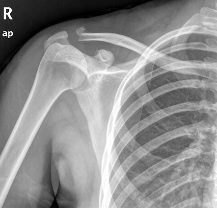 Distal clavicle fracture | Radiology Case | Radiopaedia.org