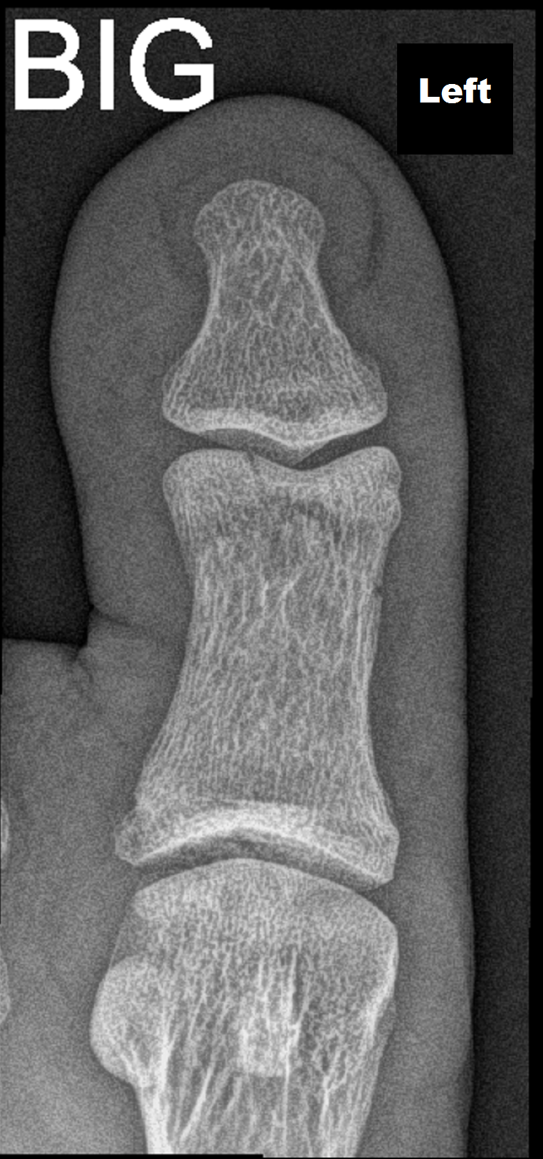 Fracture head of the proximal phalanx of the big toe | Image ...