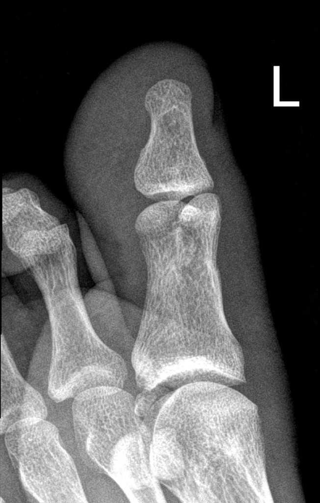 fracture-head-of-the-proximal-phalanx-of-the-big-toe