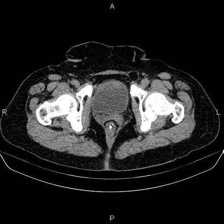 Multifocal urothelial cell carcinoma | Image | Radiopaedia.org