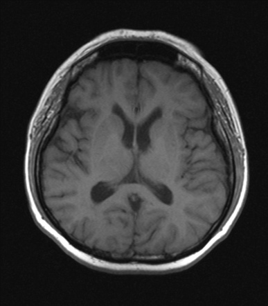 CSF leak with meningoencephalocele secondary to sphenoid bone defect ...