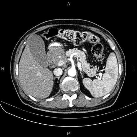 Pancreatic adenocarcinoma | Radiology Case | Radiopaedia.org