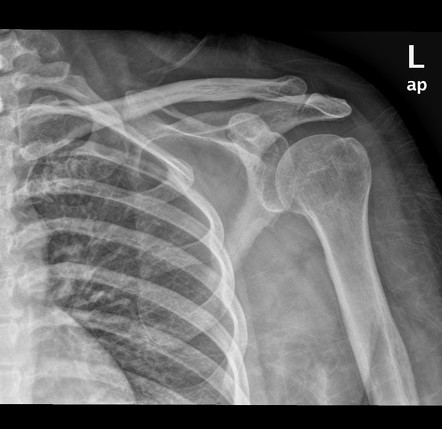 Suprascapular foramen | Image | Radiopaedia.org