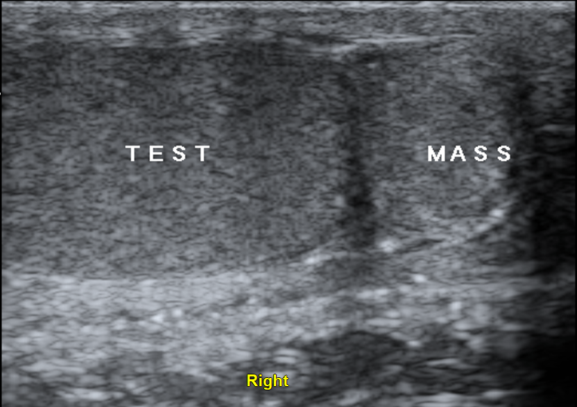 Extratesticular Adenomatoid Tumor Image