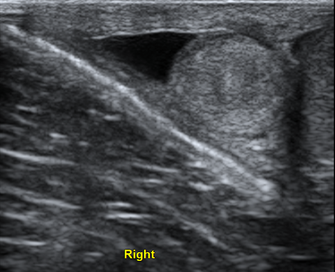 Extratesticular Adenomatoid Tumor Image