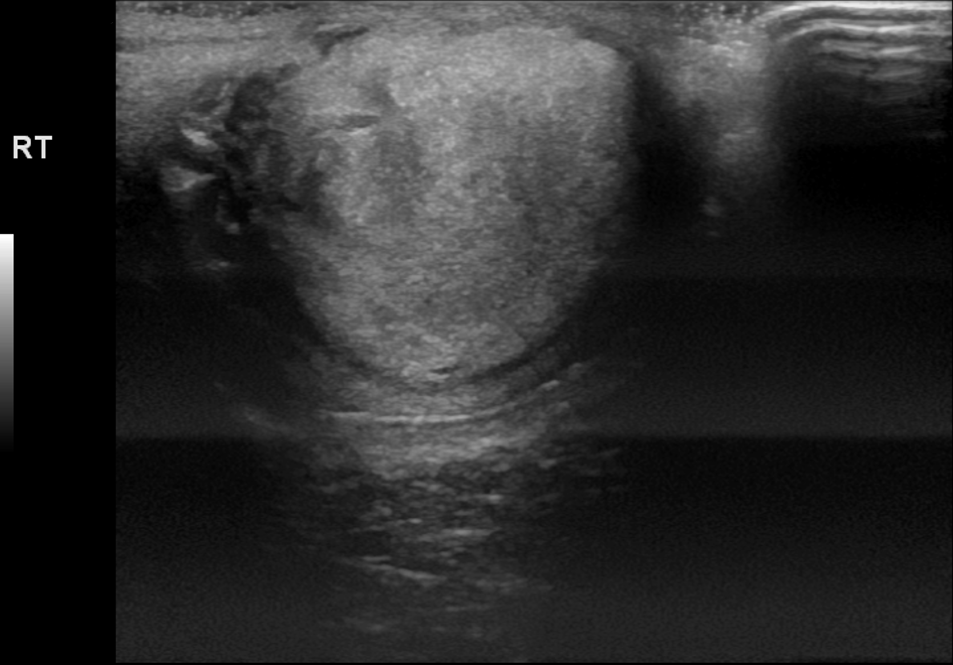 Extratesticular Adenomatoid Tumor Image