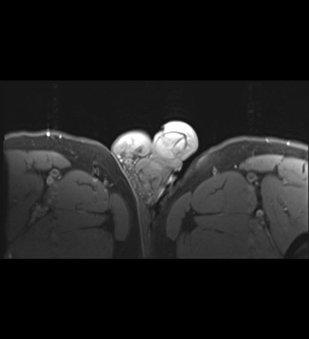 Extratesticular Adenomatoid Tumor Image