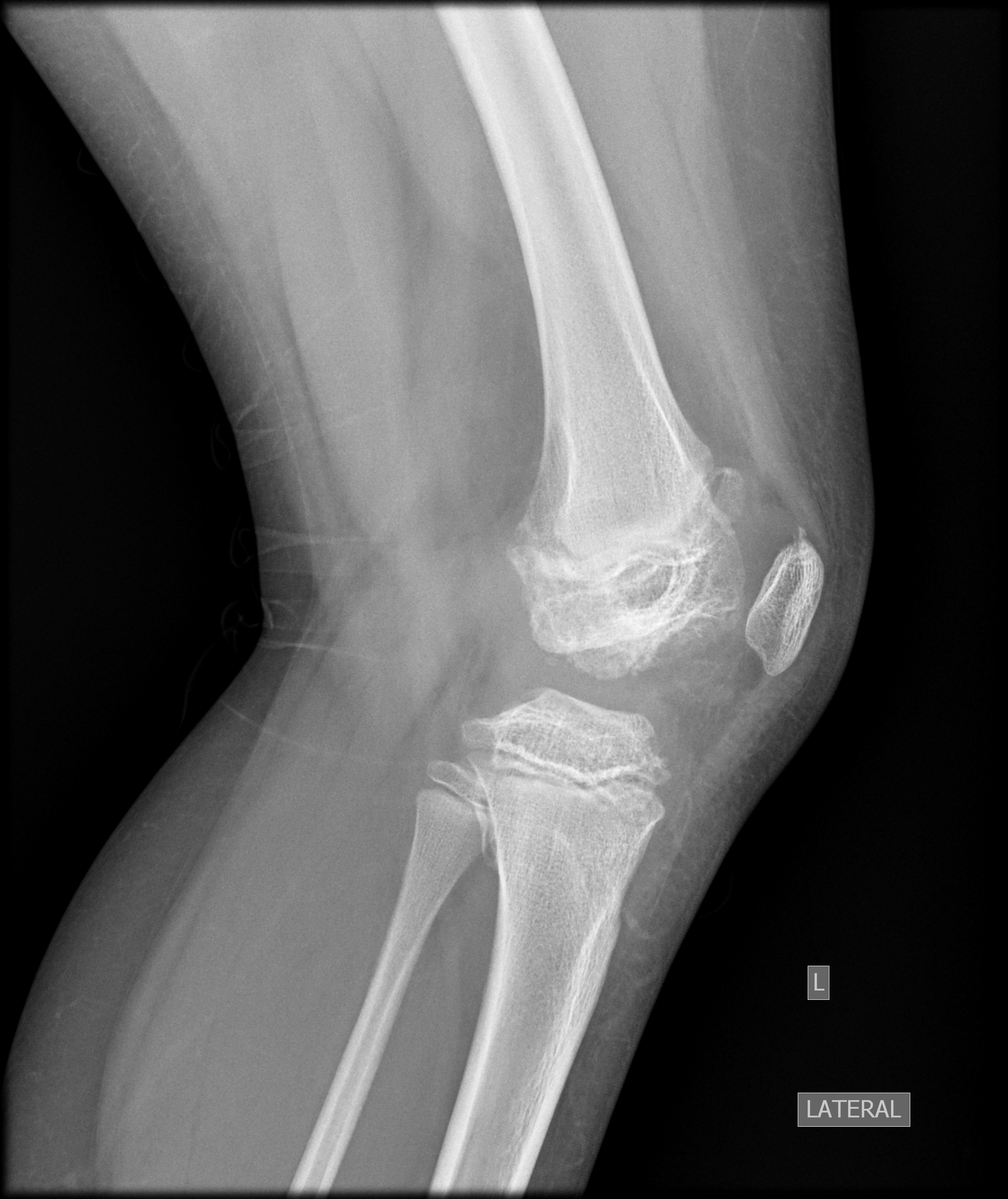 Multiple epiphyseal dysplasia | Image | Radiopaedia.org