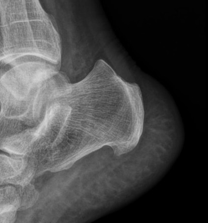 Haglund Deformity Radiology Reference Article Radiopaedia Org