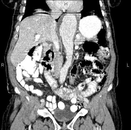 Abdominal Aortic Aneurysm | Radiology Reference Article | Radiopaedia.org