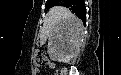 Retroperitoneal sarcoma | Image | Radiopaedia.org