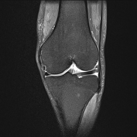 Common Peroneal (fibular) Neuropathy 