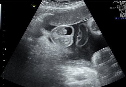 Fetal hydrocele | Radiology Reference Article | Radiopaedia.org