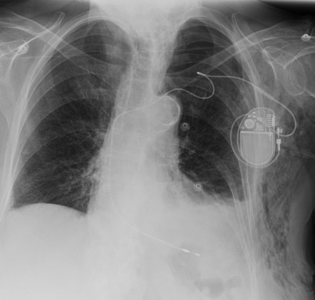 Iatrogenic Pneumothorax | Radiology Case | Radiopaedia.org