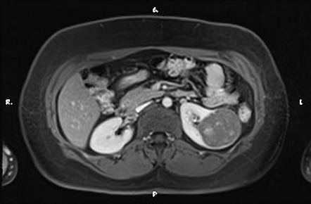 Renal Cell Carcinoma Radiology Case Radiopaedia Org