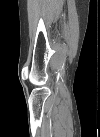 Osteochondroma-related popliteal artery pseudoaneurysm | Radiology Case ...