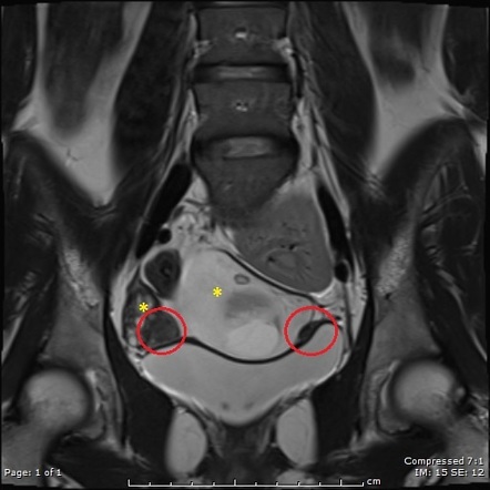 Mayer-Rokitansky-Küster-Hauser syndrome | Radiology Reference Article ...