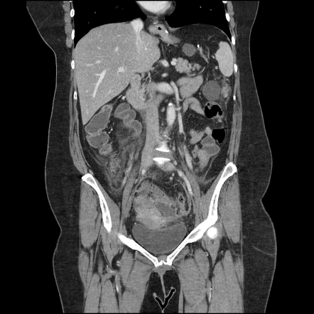 Metastatic high grade serous tubo-ovarian cancer | Image | Radiopaedia.org