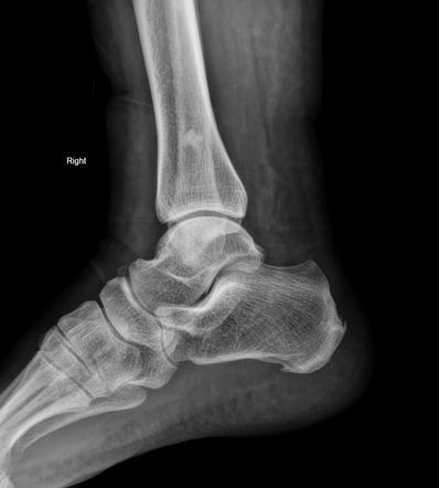 Navicular clearance bone spur