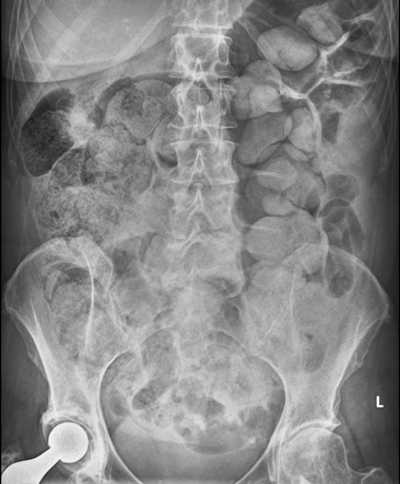 Stercoral perforation | Radiology Case | Radiopaedia.org