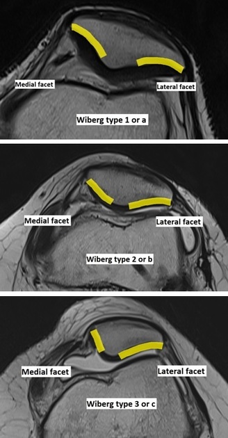 Knee sale cap shape