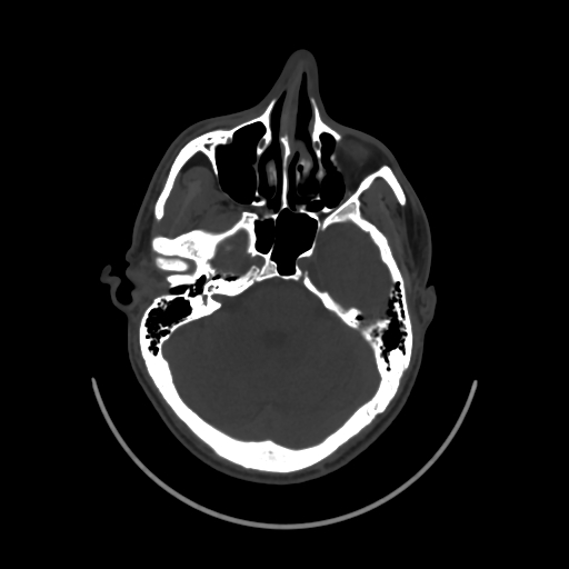 Mastoid ivory osteoma | Image | Radiopaedia.org