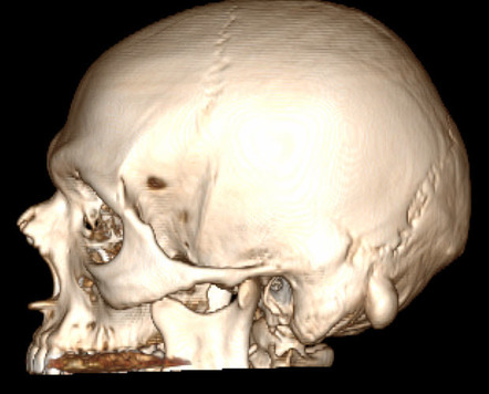 Mastoid ivory osteoma | Radiology Case | Radiopaedia.org