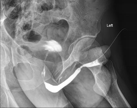 Urethral Stricture Diagram