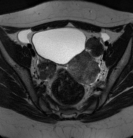 Bilateral ovarian fibrothecomas - adolescent | Radiology Case ...