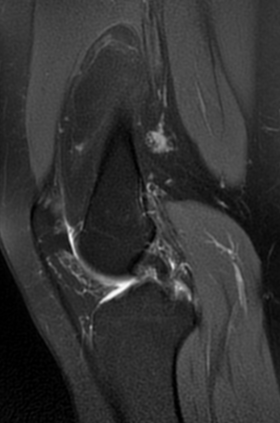 Intra-articular lipoma - knee | Image | Radiopaedia.org