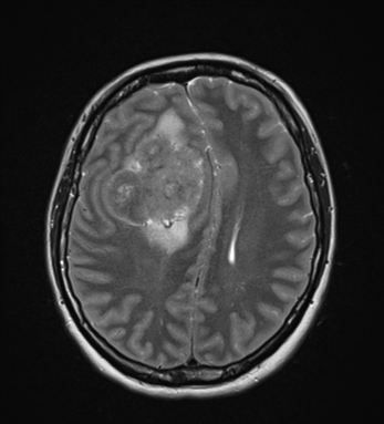 Parafalcine atypical meningioma | Image | Radiopaedia.org