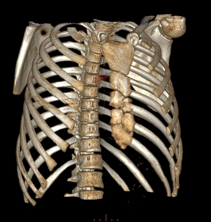 Honeycomb sterna | Radiology Case | Radiopaedia.org