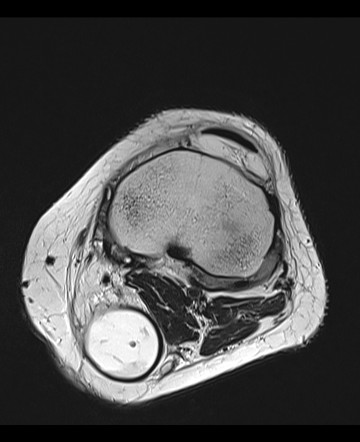 Mixed OA/RA knee arthropathy | Image | Radiopaedia.org