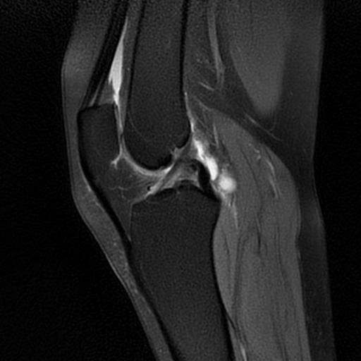 Parameniscal cyst | Image | Radiopaedia.org