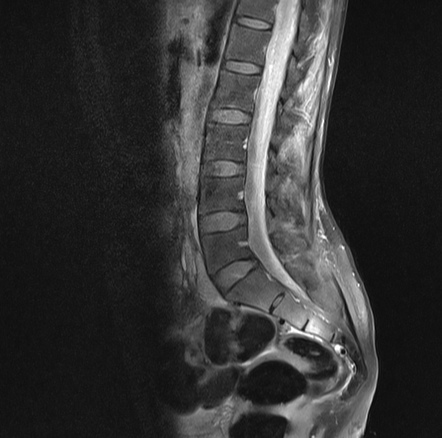 Tuberculous myelitis with intraspinal abscess | Image | Radiopaedia.org