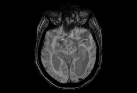 Siderosis Mri Brain