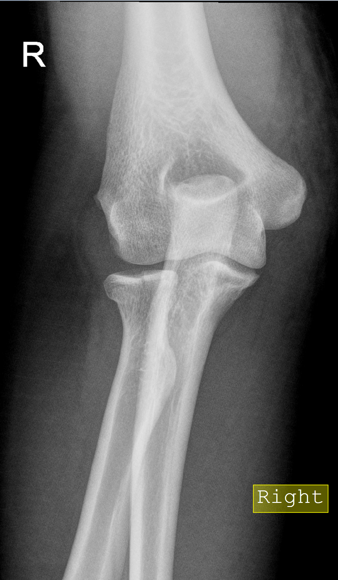 Radial Head Fracture Classification 5154