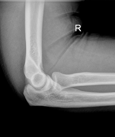 Radial head fracture | Image | Radiopaedia.org