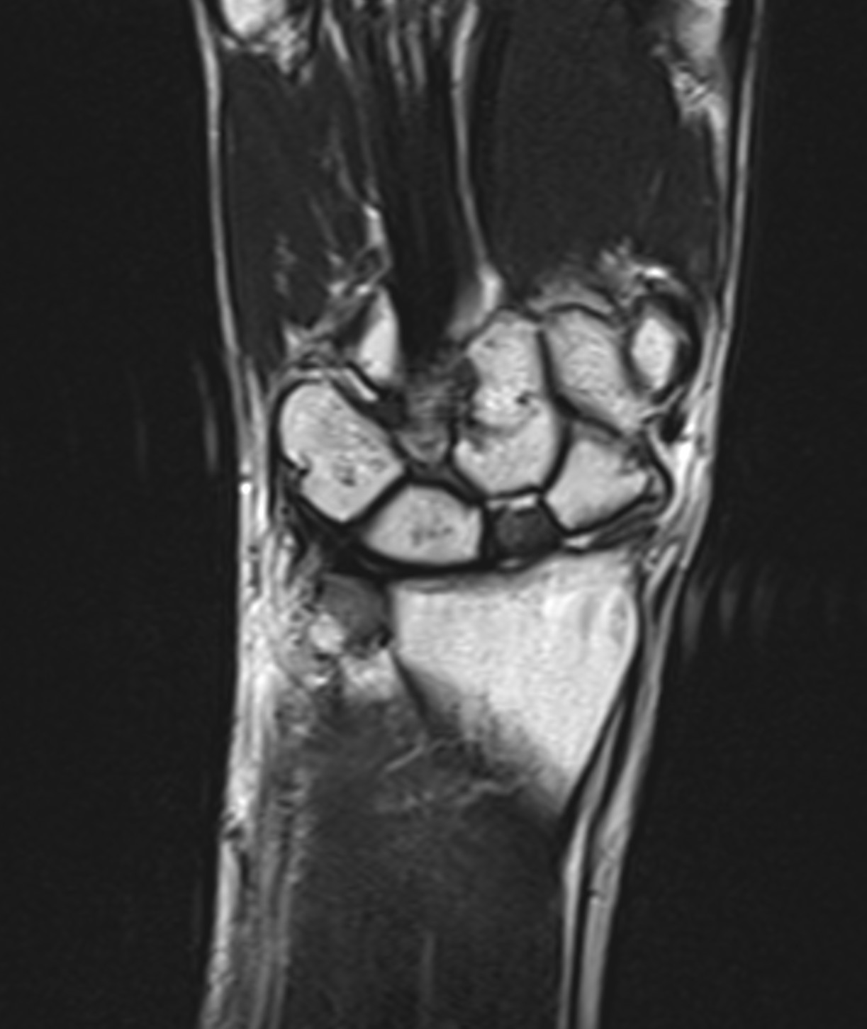 Scaphoid fracture with non-union, AVN, DISI, and SNAC | Image ...