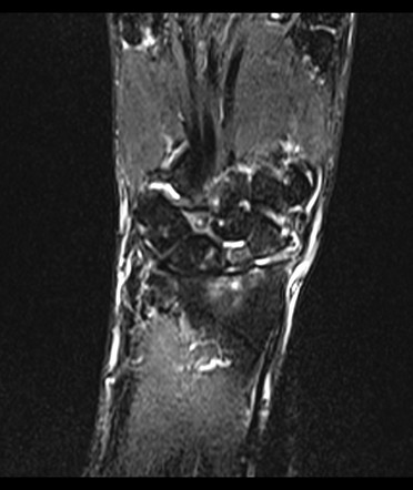 Scaphoid fracture with non-union, AVN, DISI, and SNAC | Image ...