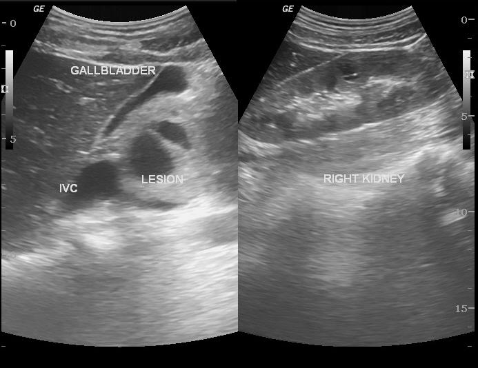 Pancreatic necrosum | Image | Radiopaedia.org