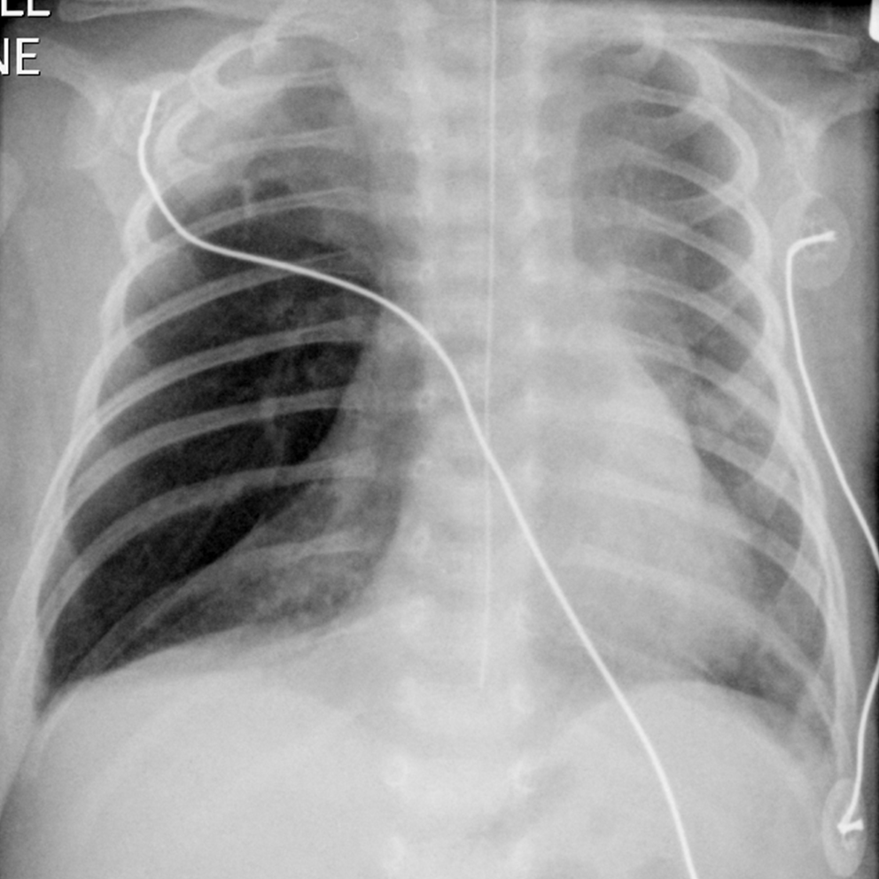 Много легких. Эмфизема с позвоночником. Органы грудной клетки фото. Middle Lobe atelectasis.