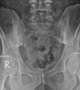 Tag: castellvi classification | Radiopaedia.org